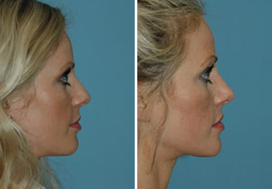 Before and after Rhinoplasty by Dr. Shervin Naderi, Patient 8875