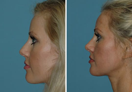 Before and after Rhinoplasty by Dr. Shervin Naderi, Patient 8875