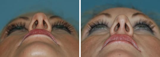 Before and after Rhinoplasty by Dr. Shervin Naderi, Patient 8875