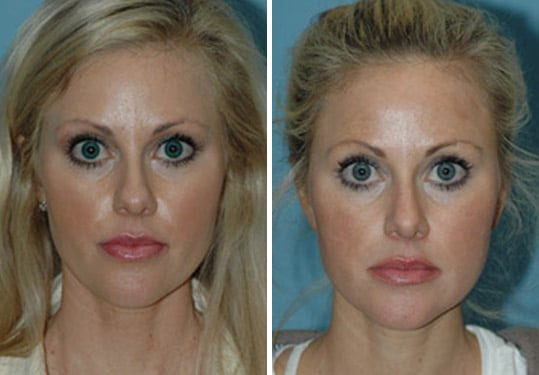Before and after Rhinoplasty by Dr. Shervin Naderi, Patient 8875