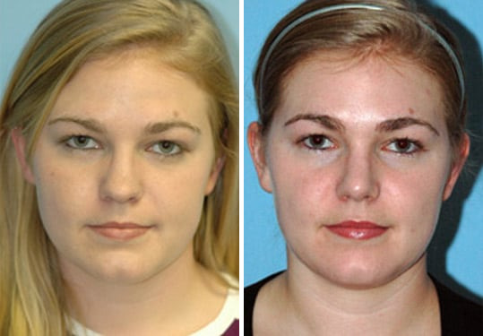 Before and after Rhinoplasty by Dr. Shervin Naderi, Patient 8876