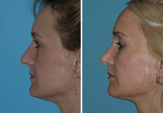 Before and after Rhinoplasty by Dr. Shervin Naderi, Patient 8877