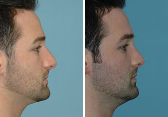 Before and after Rhinoplasty by Dr. Shervin Naderi, Patient 8878