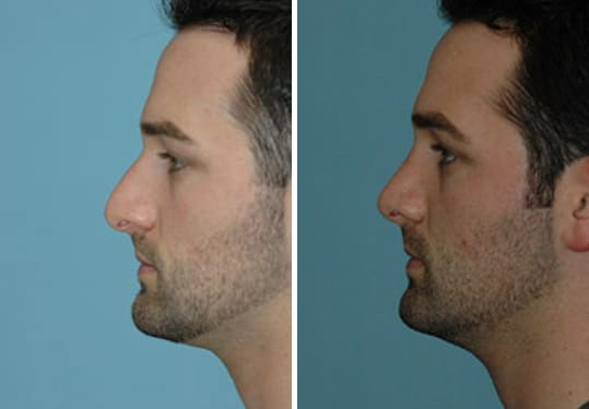 Before and after Rhinoplasty by Dr. Shervin Naderi, Patient 8878