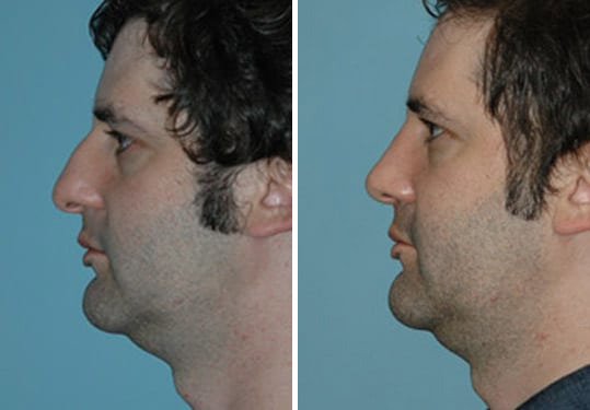 Before and after Rhinoplasty by Dr. Shervin Naderi, Patient 8879