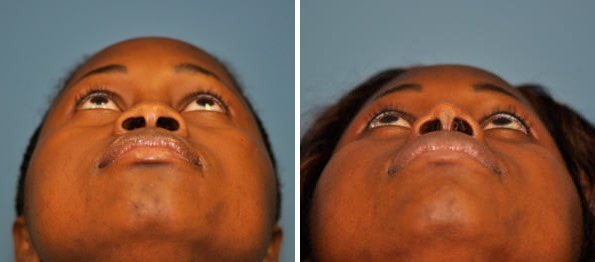 Before and after Rhinoplasty by Dr. Shervin Naderi, Patient 8882