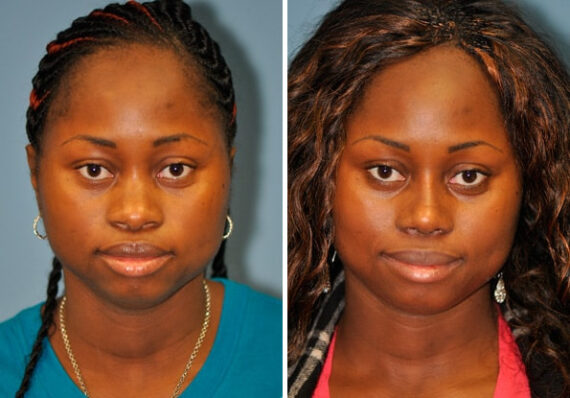 Before and after Rhinoplasty by Dr. Shervin Naderi, Patient 8882