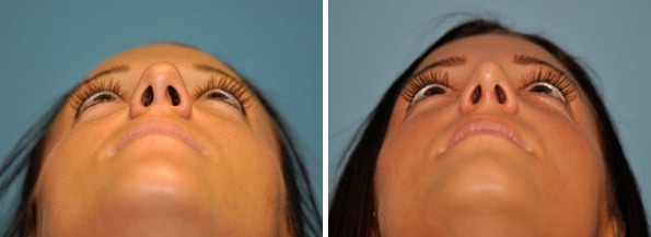 Before and after Rhinoplasty by Dr. Shervin Naderi, Patient 8883
