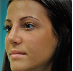 Before and after Rhinoplasty by Dr. Shervin Naderi, Patient 8883