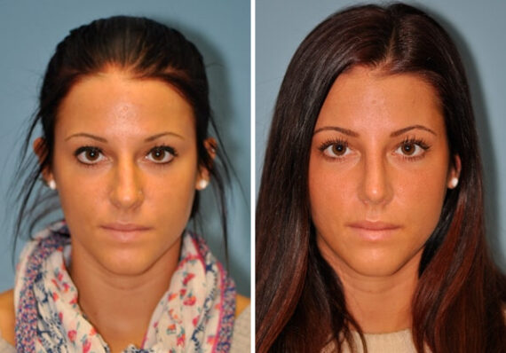 Before and after Rhinoplasty by Dr. Shervin Naderi, Patient 8883