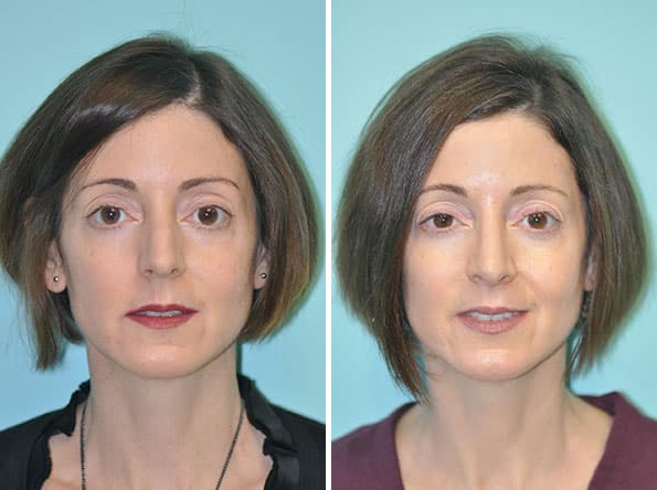 Before and after Rhinoplasty by Dr. Shervin Naderi, Patient 8886