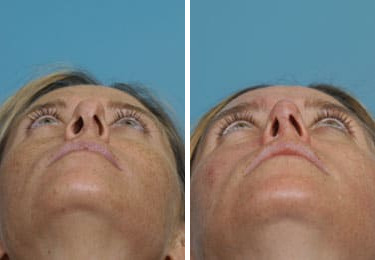 Before and after Revision Rhinoplasty by Dr. Shervin Naderi, Patient 8889
