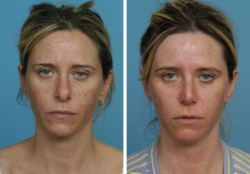 Before and after Revision Rhinoplasty by Dr. Shervin Naderi, Patient 8889