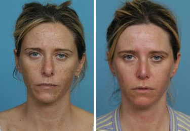 Before and after Revision Rhinoplasty by Dr. Shervin Naderi, Patient 8889