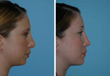 Before and after Revision Rhinoplasty by Dr. Shervin Naderi, Patient 8890