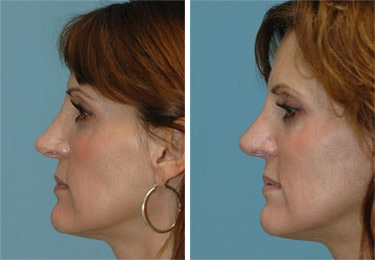 Before and after Revision Rhinoplasty by Dr. Shervin Naderi, Patient 8893