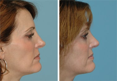 Before and after Revision Rhinoplasty by Dr. Shervin Naderi, Patient 8893