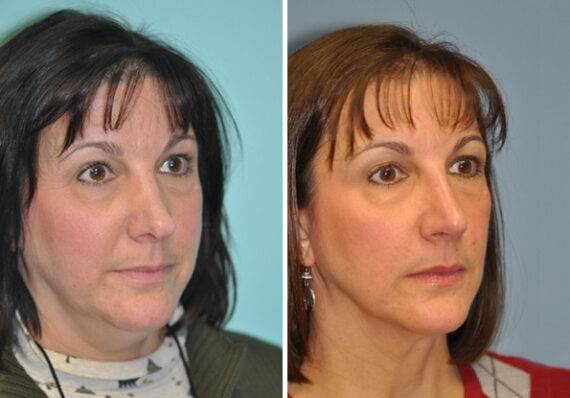 Before and after Revision Rhinoplasty by Dr. Shervin Naderi, Patient 8894