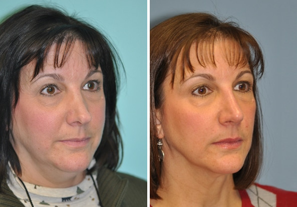 Before and after Revision Rhinoplasty by Dr. Shervin Naderi, Patient 8894