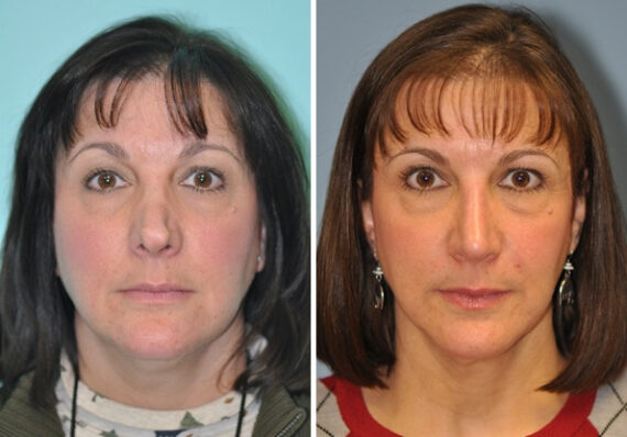 Before and after Revision Rhinoplasty by Dr. Shervin Naderi, Patient 8894