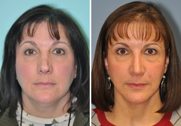 Before and after Revision Rhinoplasty by Dr. Shervin Naderi, Patient 8894