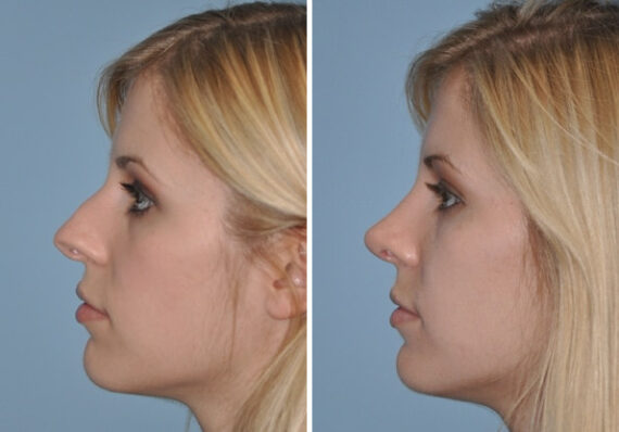 Before and after Revision Rhinoplasty by Dr. Shervin Naderi, Patient 8895