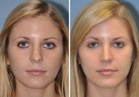 Before and after Revision Rhinoplasty by Dr. Shervin Naderi, Patient 8895