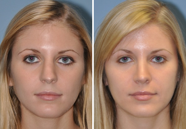 Before and after Revision Rhinoplasty by Dr. Shervin Naderi, Patient 8895