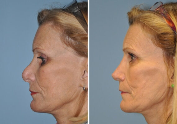 Before and after Revision Rhinoplasty by Dr. Shervin Naderi, Patient 8896