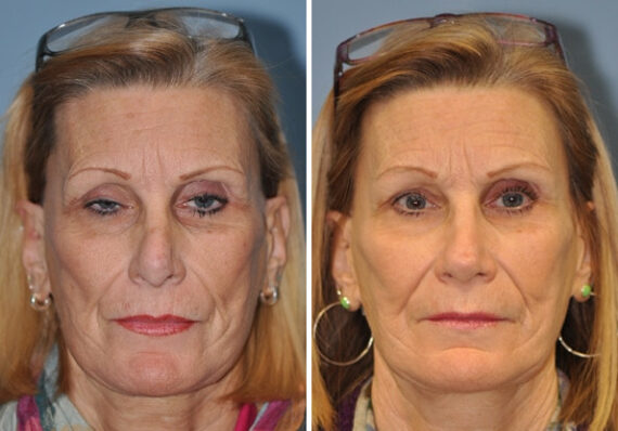 Before and after Revision Rhinoplasty by Dr. Shervin Naderi, Patient 8896