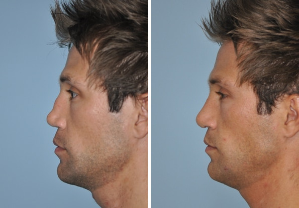 Before and after Revision Rhinoplasty by Dr. Shervin Naderi, Patient 8897