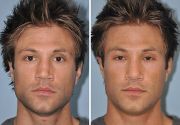 Before and after Revision Rhinoplasty by Dr. Shervin Naderi, Patient 8897