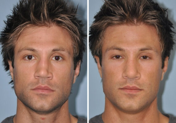 Before and after Revision Rhinoplasty by Dr. Shervin Naderi, Patient 8897