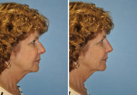 Before and after Non-Surgical Rhinoplasty by Dr. Shervin Naderi, Patient 8912