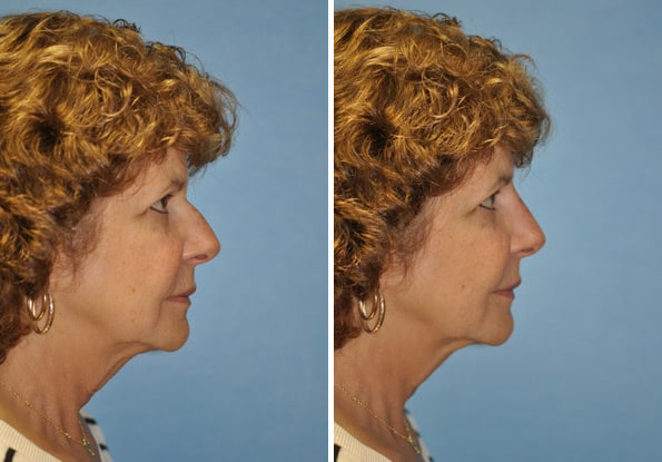 Before and after Non-Surgical Rhinoplasty by Dr. Shervin Naderi, Patient 8912