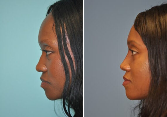 Before and after Non-Surgical Rhinoplasty by Dr. Shervin Naderi, Patient 8913