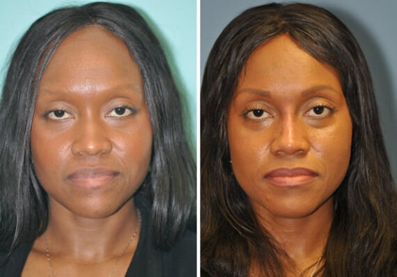 Before and after Non-Surgical Rhinoplasty by Dr. Shervin Naderi, Patient 8913