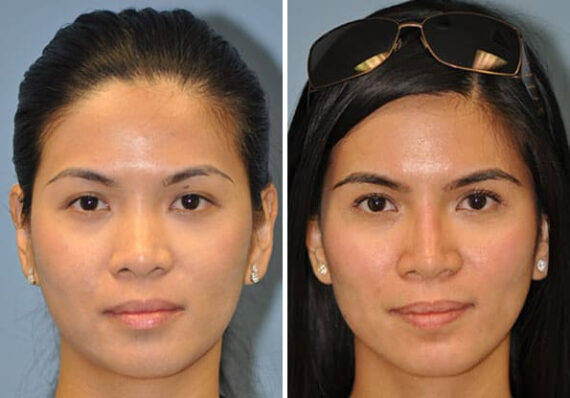 Before and after Non-Surgical Rhinoplasty by Dr. Shervin Naderi, Patient 8914