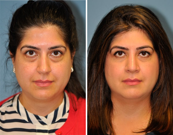 Before and after Blepharoplasty by Dr. Shervin Naderi, Patient 8918