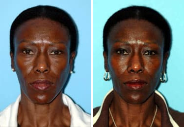 Before and after Blepharoplasty by Dr. Shervin Naderi, Patient 8924