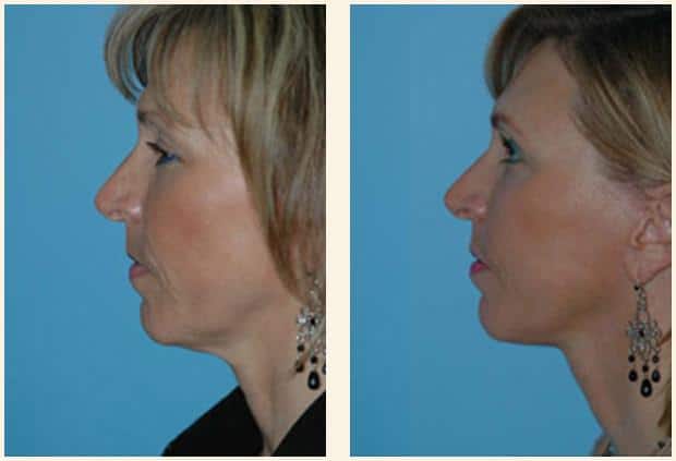 Facelift performed by top surgeon, Dr. Shervin Naderi in Reston, Virginia and Chevy Chase, Maryland at The Naderi Center