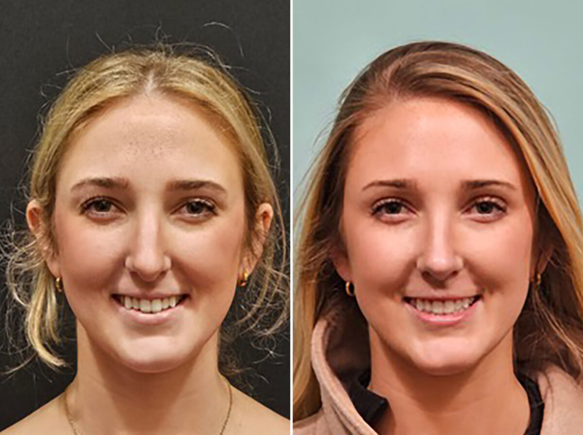 Before and after Rhinoplasty by Dr. Shervin Naderi, Patient 48189