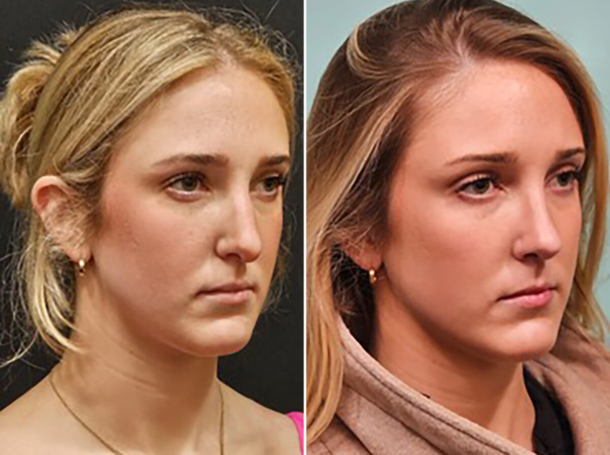 Before and after Rhinoplasty by Dr. Shervin Naderi, Patient 48189