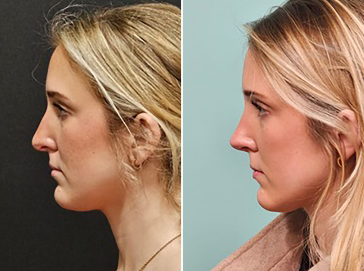 Before and after Rhinoplasty by Dr. Shervin Naderi, Patient 48189