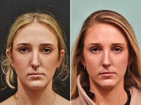 Before and after Rhinoplasty by Dr. Shervin Naderi, Patient 48189