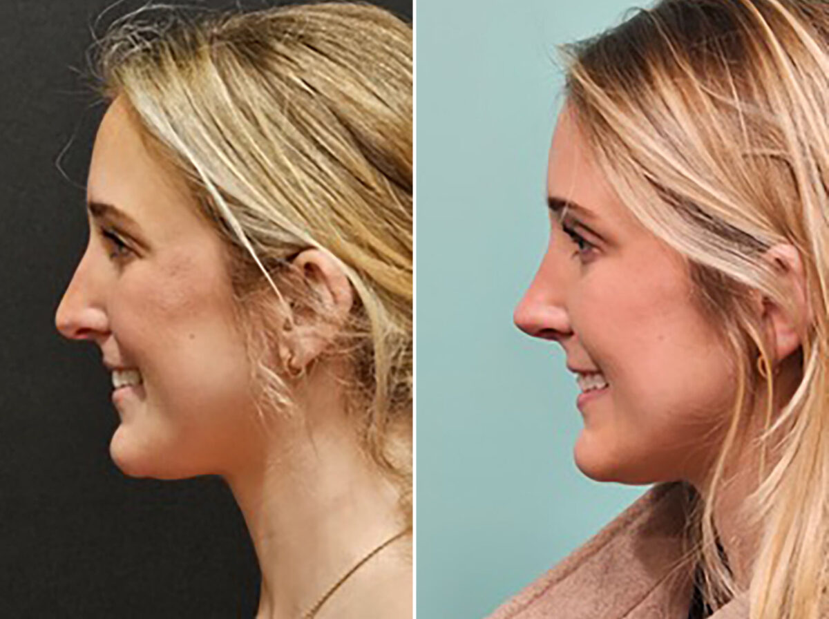 Before and after Rhinoplasty by Dr. Shervin Naderi, Patient 48189