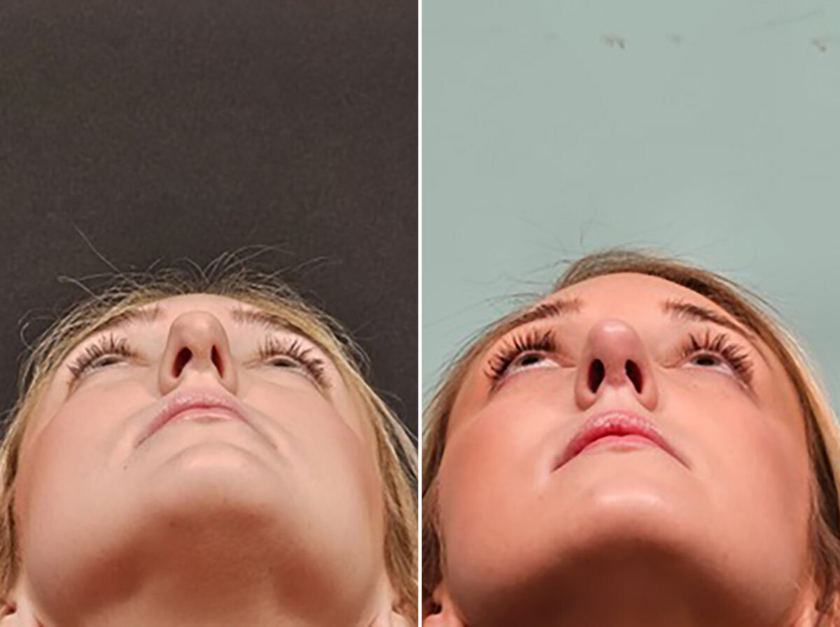 Before and after Rhinoplasty by Dr. Shervin Naderi, Patient 48189