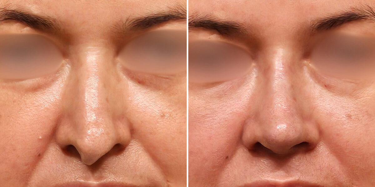 Before and after Revision Rhinoplasty by Dr. Shervin Naderi, Patient 48214