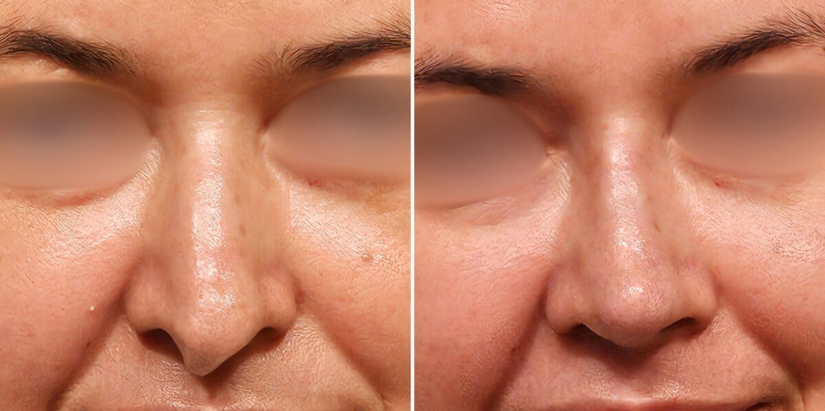 Before and after Revision Rhinoplasty by Dr. Shervin Naderi, Patient 48214