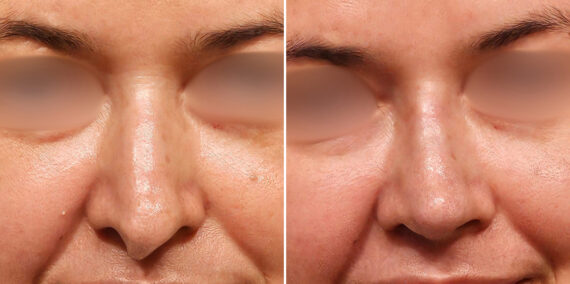 Before and after Revision Rhinoplasty by Dr. Shervin Naderi, Patient 48214